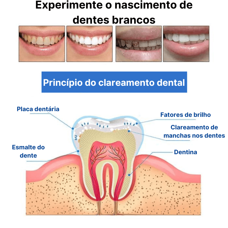 🔥Caneta de Limpeza e Clareamento Dental