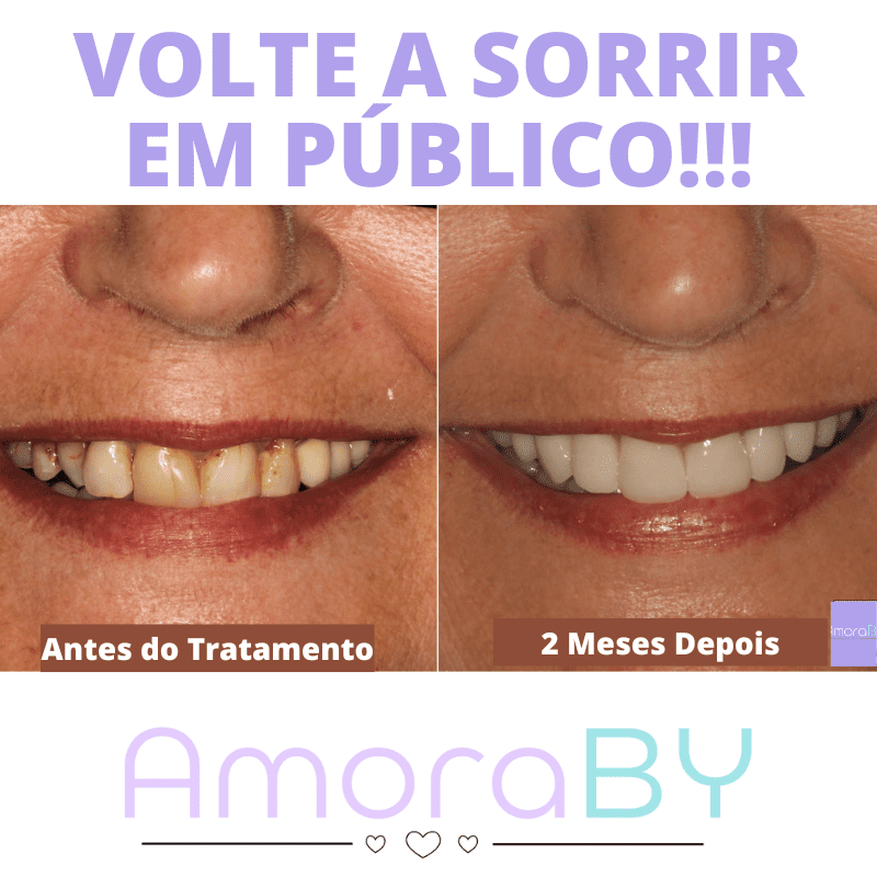 V34 Hismile - Renovação Dental